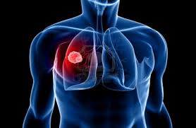 What are the symptoms of mesothelioma?
